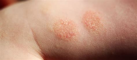 O que causa dermatite atópica Como preveni la e tratá la