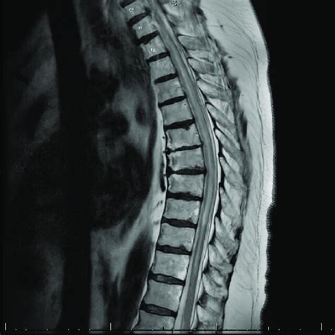 MRI Of The Thoracic Spine Sagittal T Weighted Image Showing Multilevel Download Scientific