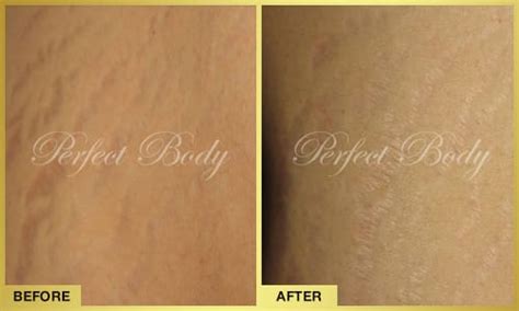Stretch Mark Reduction Gallery Perfect Body Laser And Aesthetics