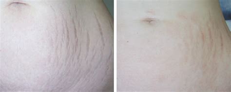 Stretch Mark Removal London And Surrey Premier Laser Clinic