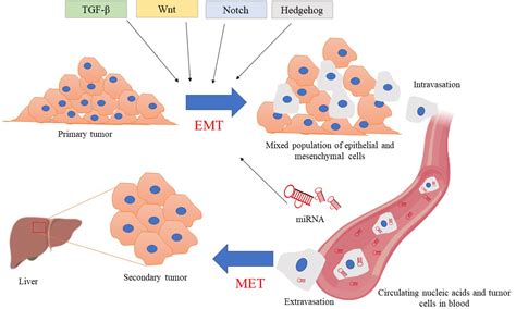 emt in breast cancer metastasis an interplay of micrornas signaling pathways and circulating