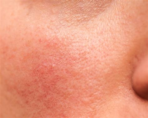 Rosacea A Common Skin Condition Treated By Dr Jeffrey Ross Gunter And