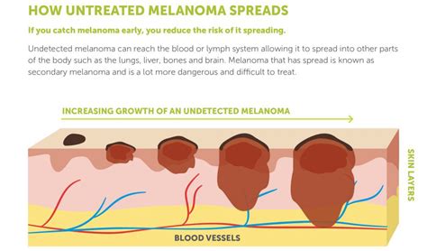 Melanoma Skin Cancer Symptoms And Signs