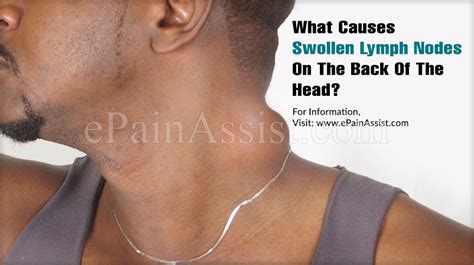 What Causes Swollen Lymph Nodes On The Back Of The Head
