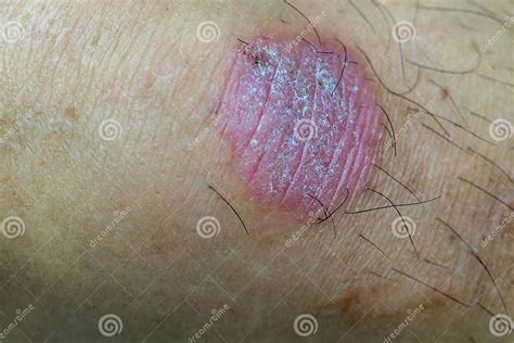 Ring Infecção Pelo Verme Dermatophytose Na Pele Infecção Por Ringworm