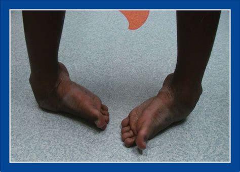 Clubfoot Foot And Ankle Deformities Principles And Management Of