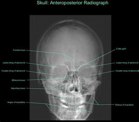 Frontal Radiograph Of Skull Anatomy Images Medical Radiography Anatomy