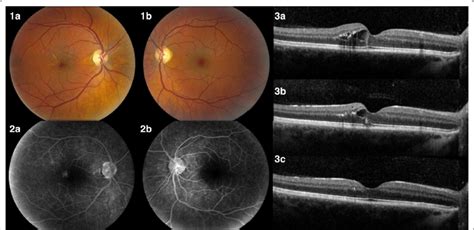 1 Fundus At Diagnosis Of Macular Edema The Right Eye Has Moderate Me