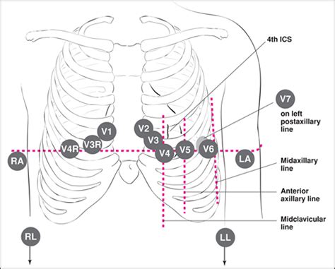 Electrocardiogram Electrode Placement