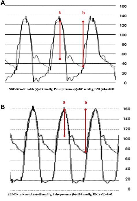 Aortic Pressure Tracing Post Tavr For A Patient With And Without