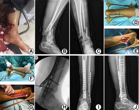 In rockwood and wilkins' fractures in children, 7th ed. a-c 24-year-old man sustained a left open distal tibial ...