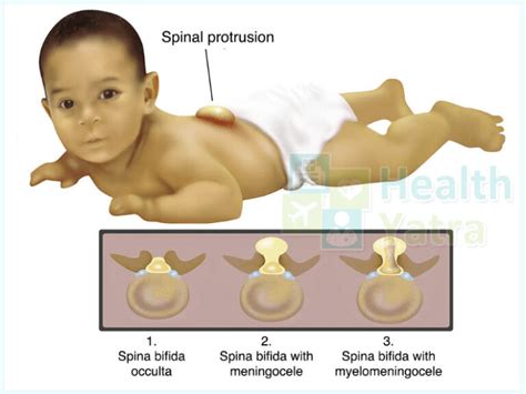 Spina Bifida Treatment In India Causes Signs Symptoms Updated 2023