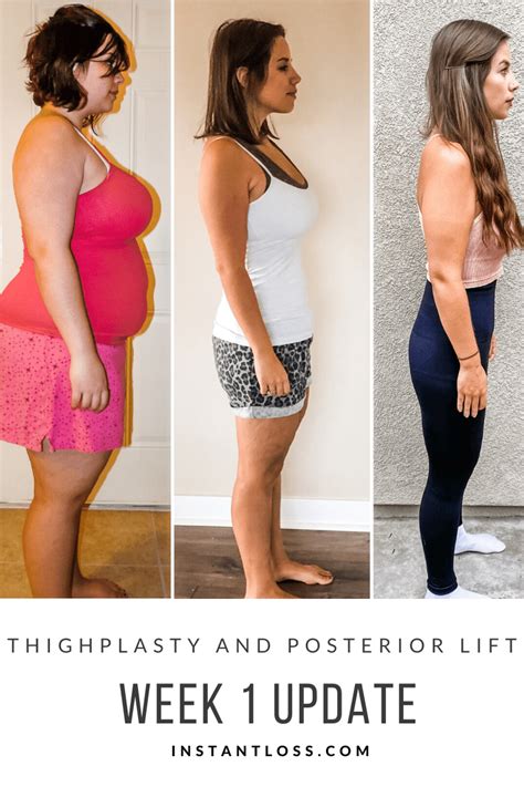 Thighplasty And Posterior Lift Week 1 Update Instant Loss Conveniently Cook Your Way To