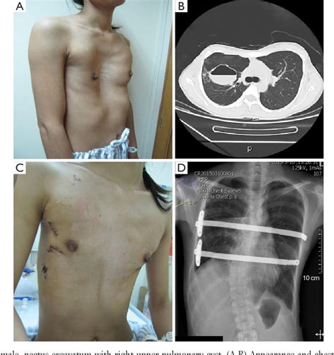 This page is a casual forum for people to express their concerns, find support or just gather info. Figure 8 from Surgical correction of 639 pectus excavatum ...