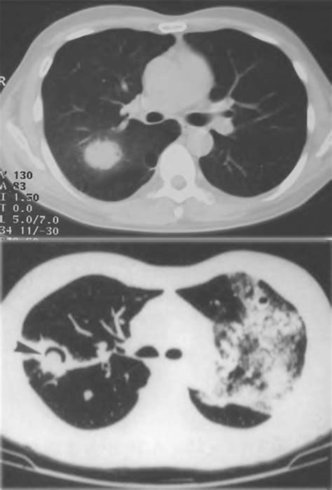 Representative Radiographic Pictures Of Pulmonary Cryptococcosis Ct