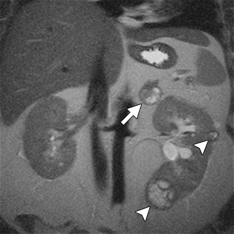 Ct And Mr Imaging For Evaluation Of Cystic Renal Lesions And Diseases
