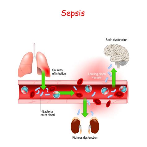 Find the perfect sepsis stock photos and editorial news pictures from getty images. Tulsa Sepsis Lawyers | Nursing Home Abuse | My Nursing Home Lawyer