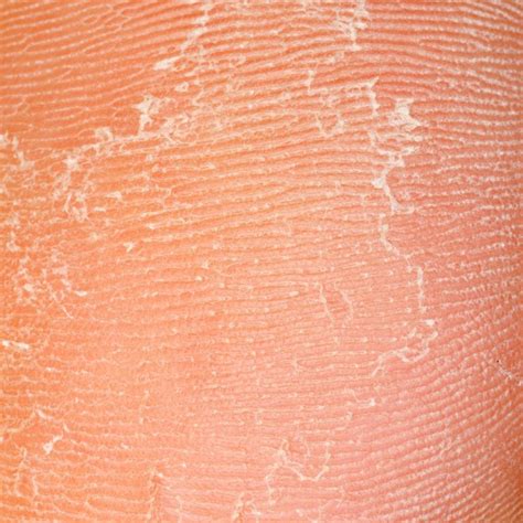 Peeling Feet Causes Symptoms Home Remedies Pictures