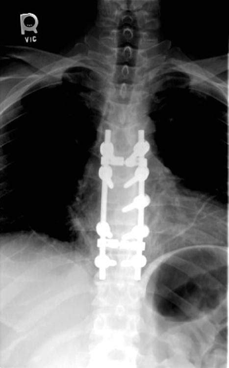 The Lateral Extracavitary Approach To The Thoracolumbar Spine A Case