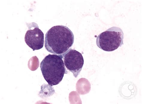 Precursor T Cell Acute Lymphoblastic Leukemia 3
