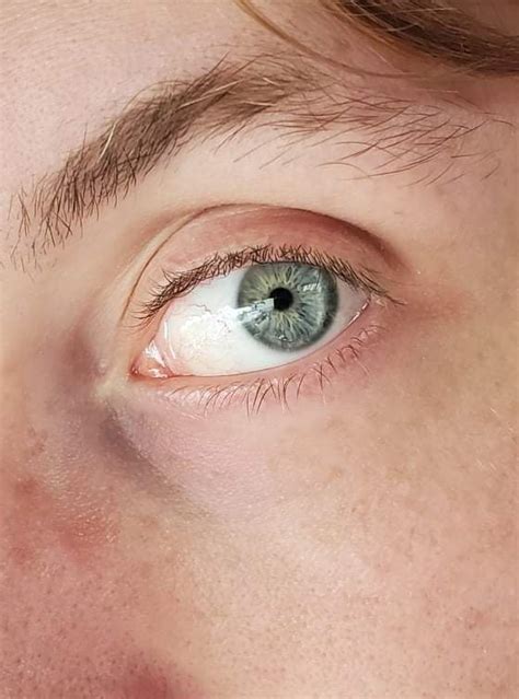 My Wife Just Noticed My Left Pupil Has Developed A Crescent Moon Shape