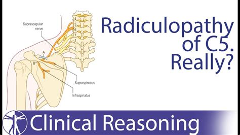 Suprascapular Nerve Entrapment Mimicking C Radiculopathy Youtube Hot