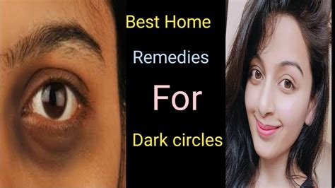 How To Remove Dark Circles At Home Ll Best Home Remedies For Dark
