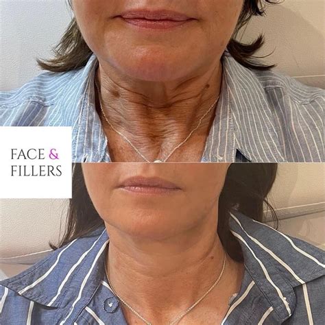Neck Botox Treatment In Surrey Face And Fillers
