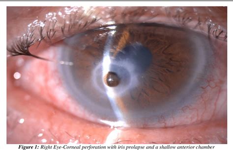 Figure 2 From Autologous Corneal Patch On Perforated Herpetic Corneal