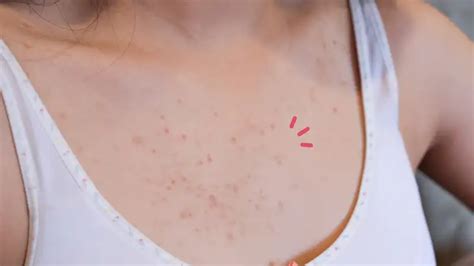 Mengenal Infeksi Jamur Fungal Acne Dan Cara Mengatasinya Orami