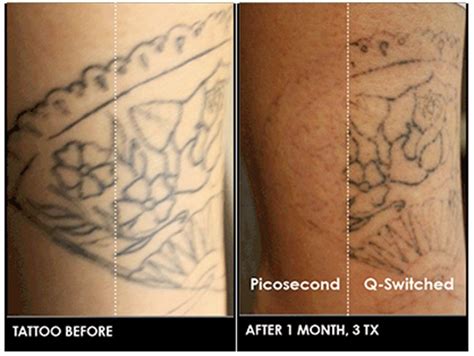 Laser Tattoo Removal Virginia Beach David H Mcdaniel Md Laser