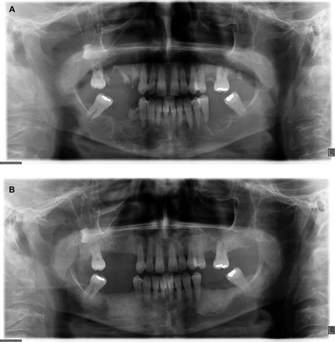 Hyperparathyroidism Diagnosed Due To Brown Tumors Of The Jaw A Case