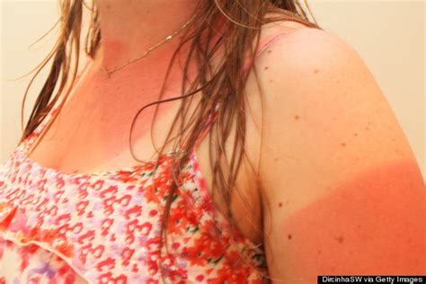 10 Tips For Treating A Bad Sunburn Huffpost