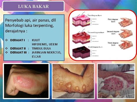 Luka Wound Vulnus Oleh Prof Kamardi Thalut Definisi