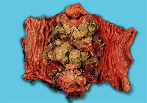 In order, its parts are the cecum, the ascending colon, the transverse colon, the descending colon, the sigmoid colon, the rectum, and the anal canal. Colon Cancer Photograph by Medimage/science Photo Library