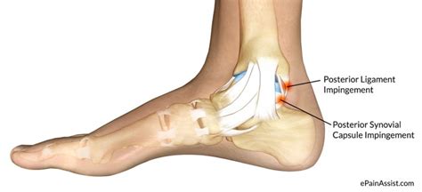 Posterior Ankle Impingement Overview And Treatment Capital Area Pt