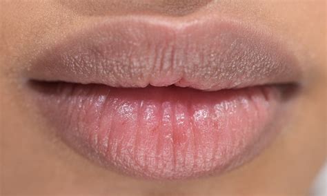 How To Treat Chapped Lips Overnight In Three Easy Steps — Photos