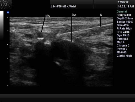 New Approach Of Ultrasound Guided Genitofemoral Nerve Block In Addition