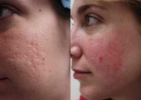 How To Cure Hormonal Acne Naturally What Helps To Clear