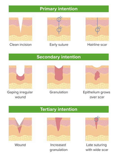 Wound Healing Concise Medical Knowledge