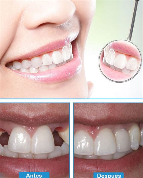 Rehabilitación Oral Ríosilva Clínica Dental