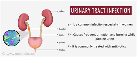 How To Prevent Urinary Tract Infection Recurrence Without Antibiotics