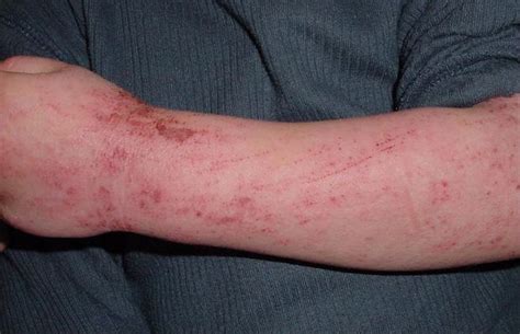 What Are The Different Types Of Eczema