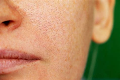 How To Get Rid Of Open Pores On Nose 3 Ways To Remove Blackheads On