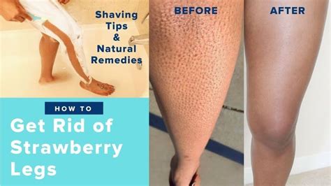 How To Get Rid Of Strawberry Legs Strawberry Legs How To Remove