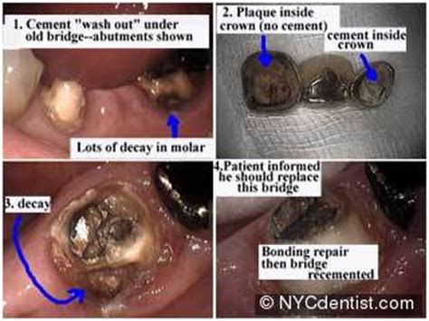 If your tooth is broken, chipped, or fractured, see your dentist as soon as possible. Dental cements luting agents and glue for crowns- NYC Dentist