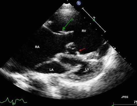 Tricuspid Valve Dysplasia From Foetus To Adult Thoracic Key