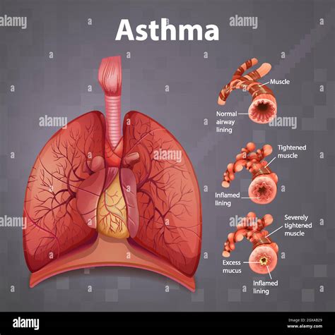 Humano Bronquial Asma Inflamado Tubo Anatomia Diagrama Humano Images