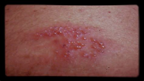 Dangerous Skin Infection Happend By Polluted Water Youtube