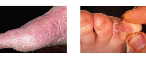 Fungal Skin Infection In The Foot The Hartland Podiatry Clinic